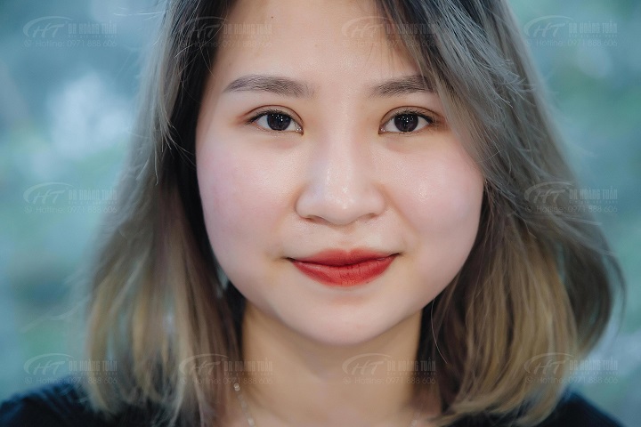 Mí vào nếp tự nhiên, hết sưng hoàn toàn sau 2 tháng cắt mí